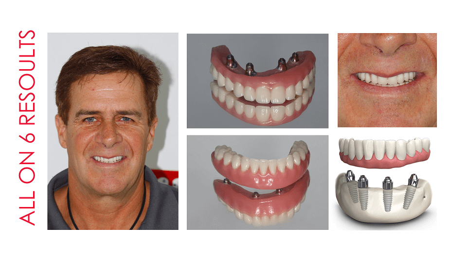 All On 6 Costa Rica Dental Implants